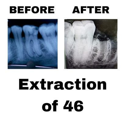 Extraction of 46 Extraction of 46