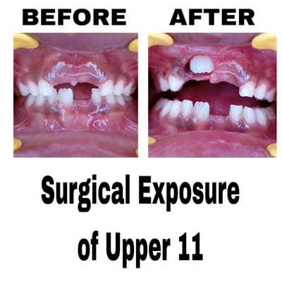 Surgical Exposure of Uppre 11