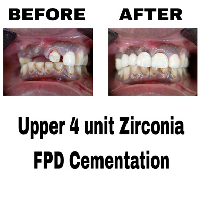 Upper 4 unit Zirconia FPD Cementation Upper 4 unit Zirconia FPD Cementation