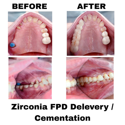 Zirconia FPD Delevary Cementation Zirconia FPD Delevary Cementation